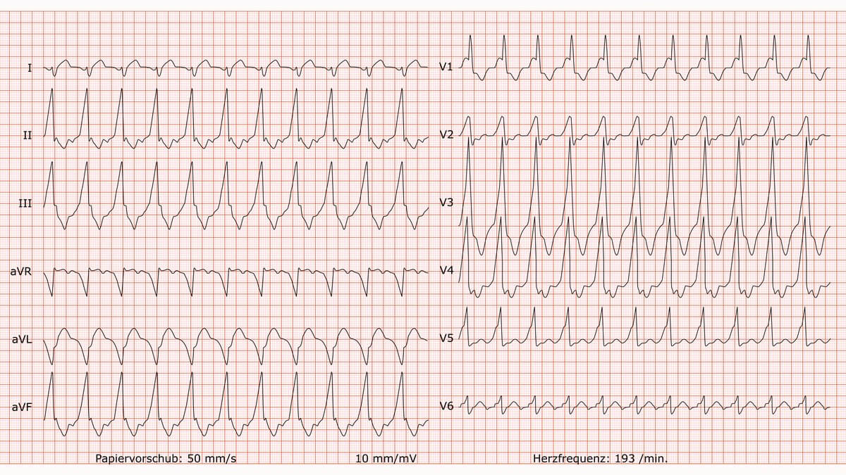 12-Kanal-EKG bei antidromer AV-Reentrytachykardie