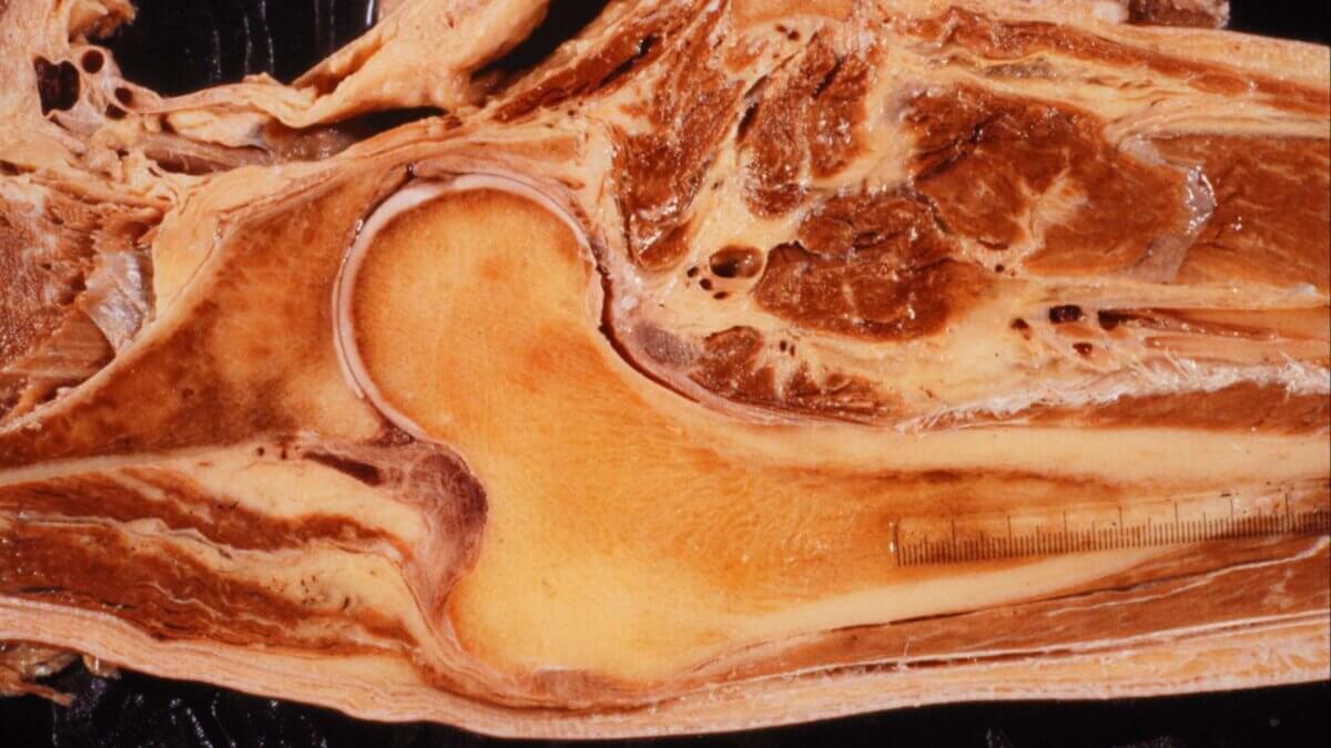 Frontalschnitt Caput femoris