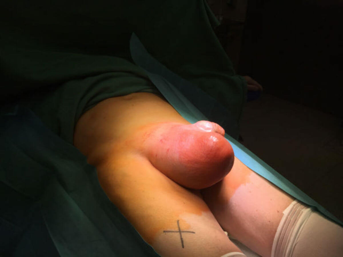 Leistenhernie rechts