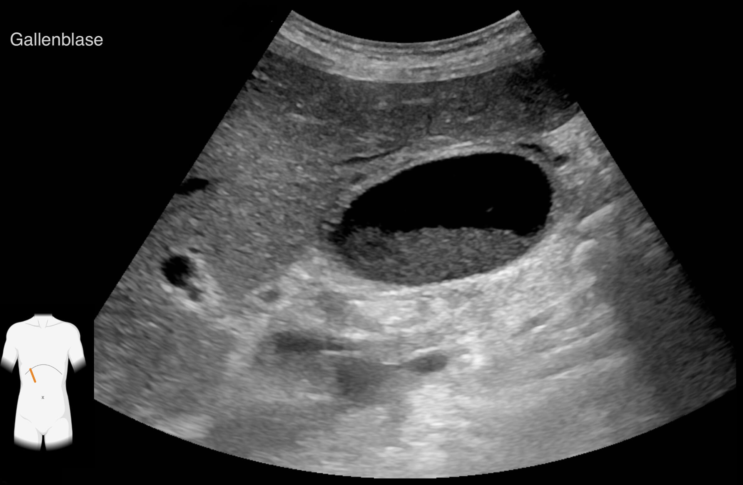 gallenblase_fin_original.jpg