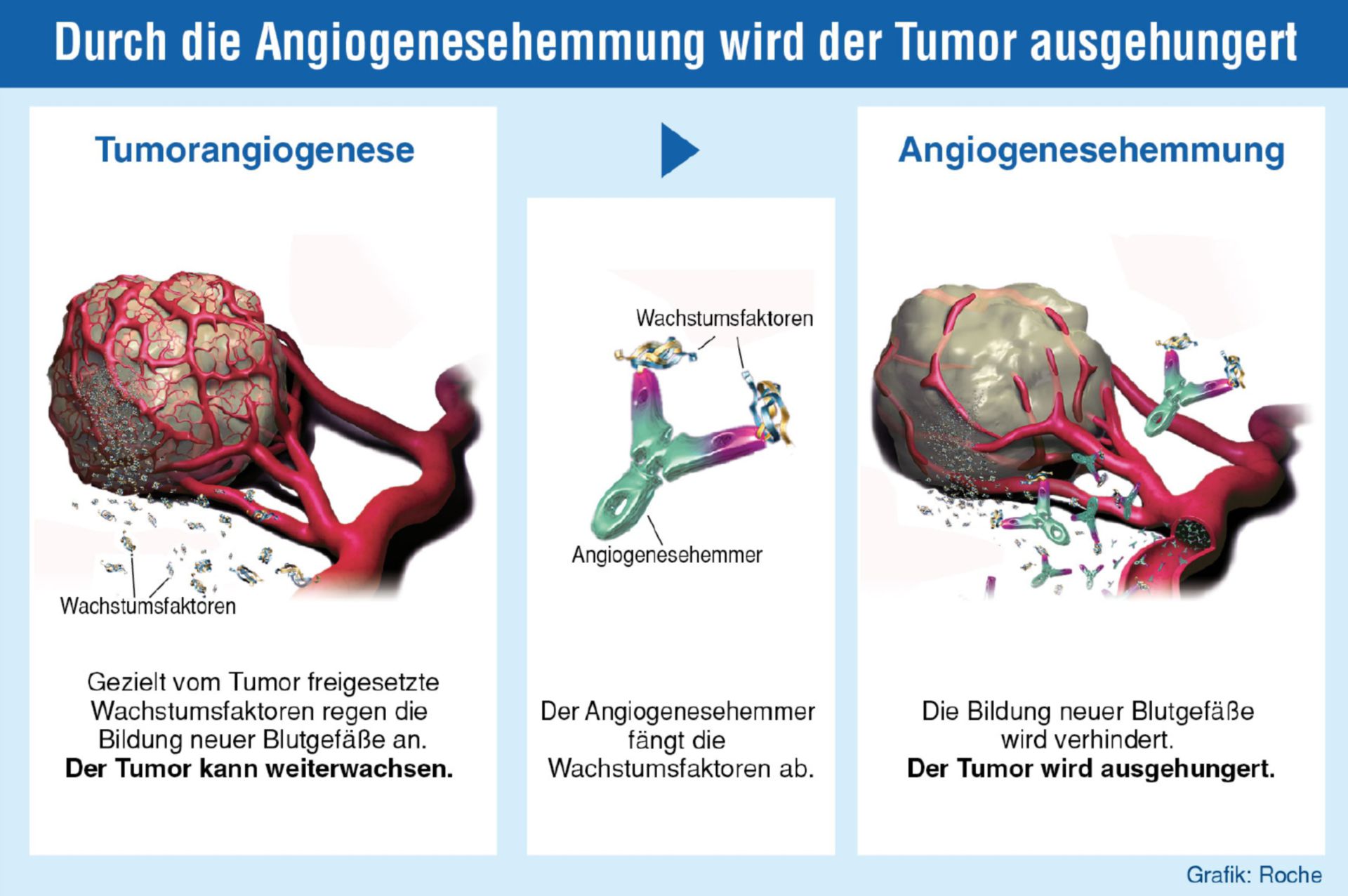 The tumor is starved by the inhibition of angiogenesis