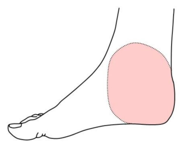 Medial retromalleolar region - DocCheck