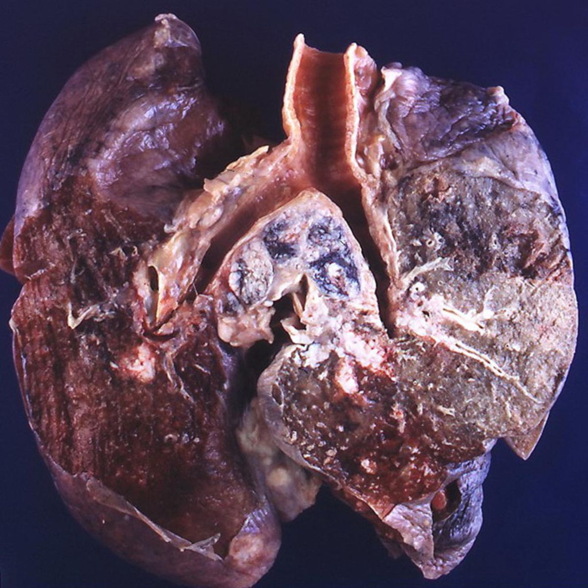 Kleinzelliges Bronchialkarzinom (Präparat)