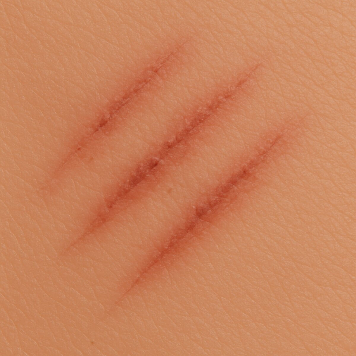 Kratzwunde