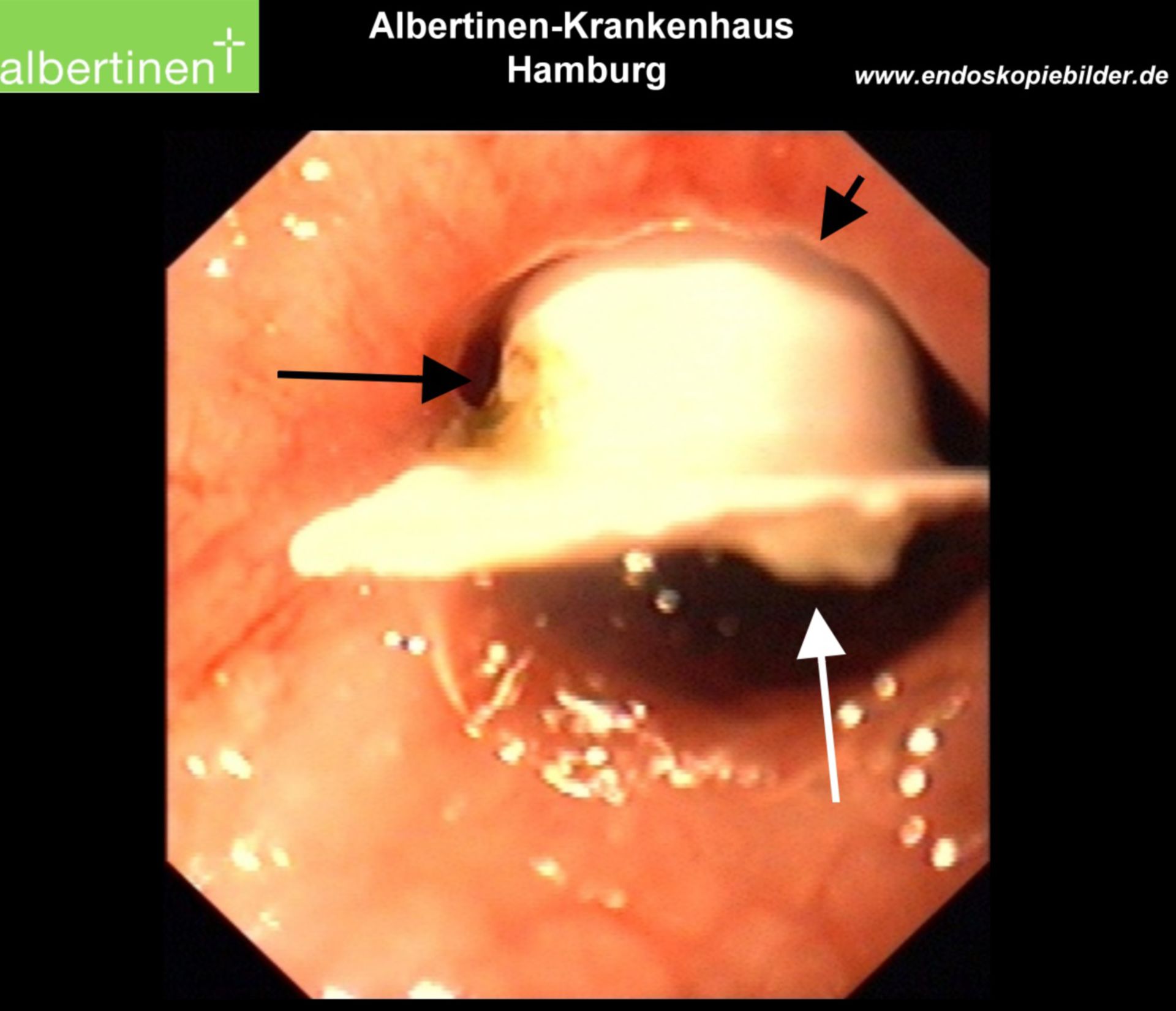 Endoscopy: Forein body in the esophagus