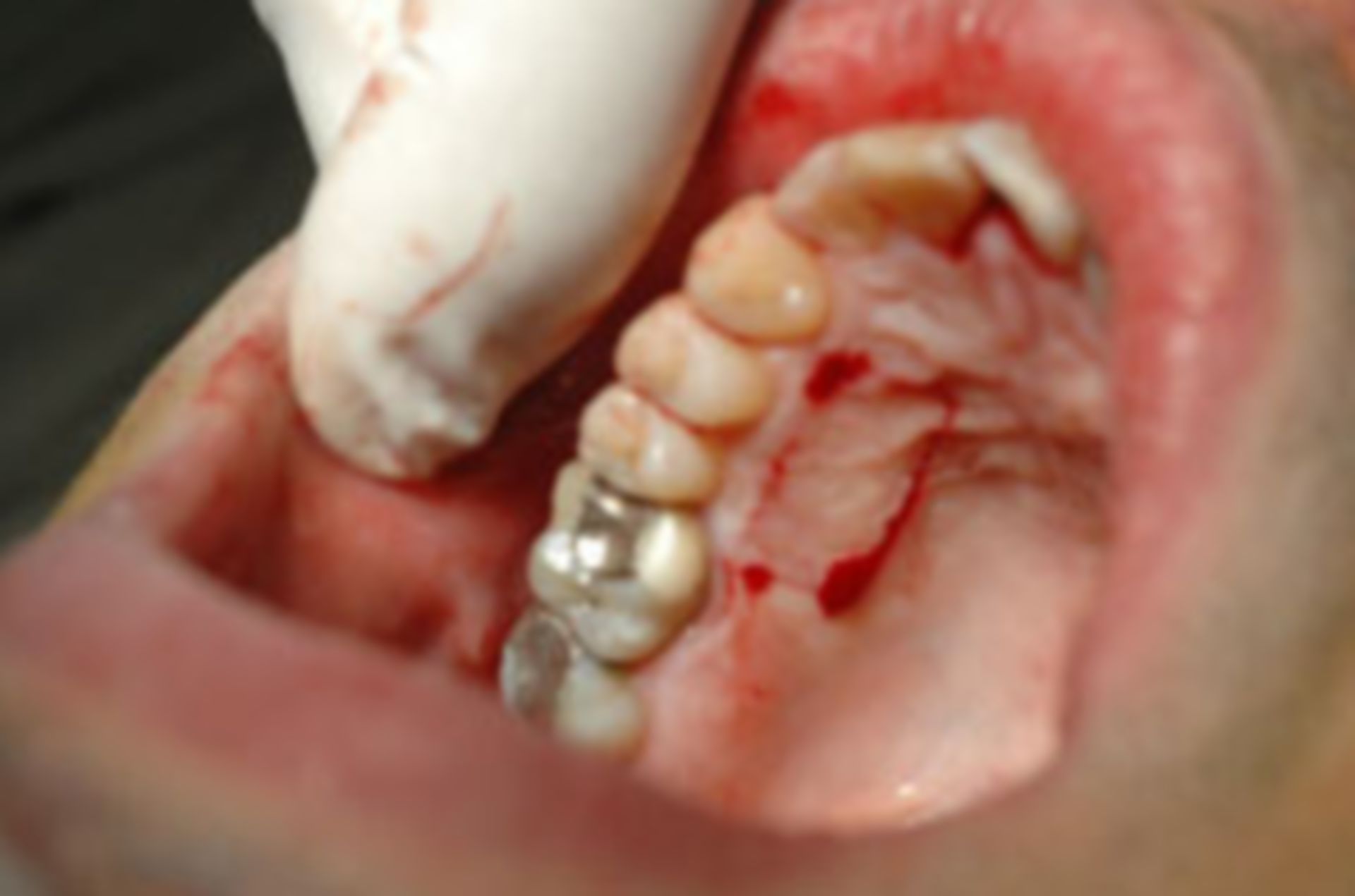 Intraoraler Befund bei Erhebung des Zahnstatus