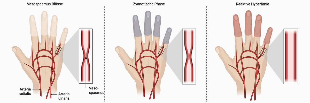 Raynaud-Syndrom Phasen