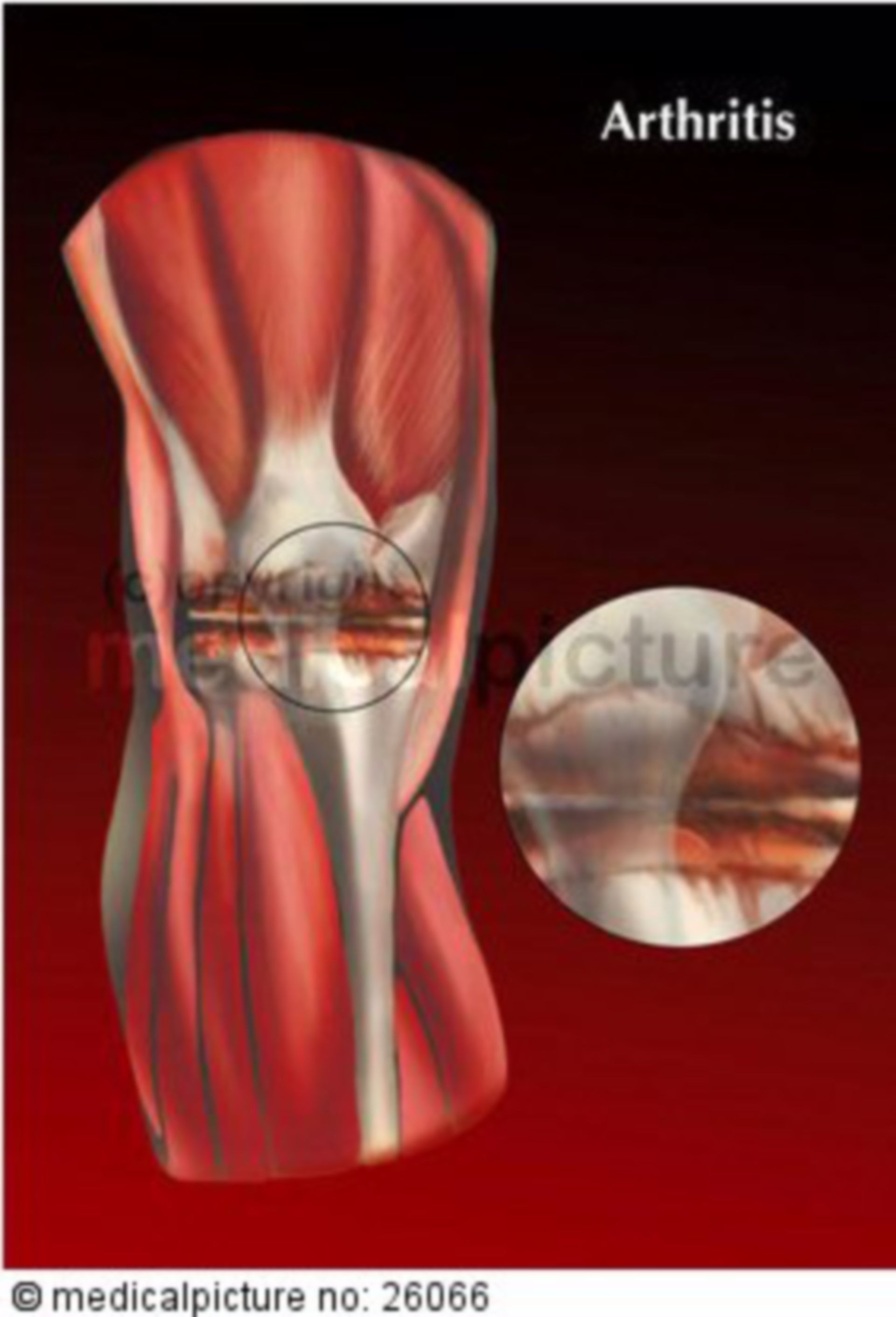  Arthritis im Kniegelenk 
