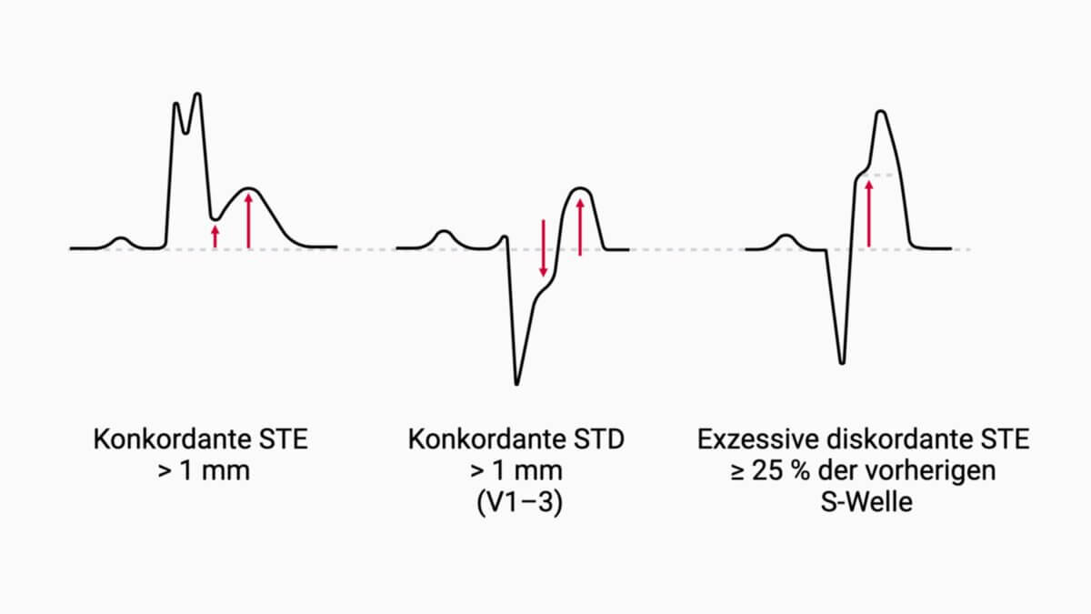Modifizierte Sgarbossa-Kriterien