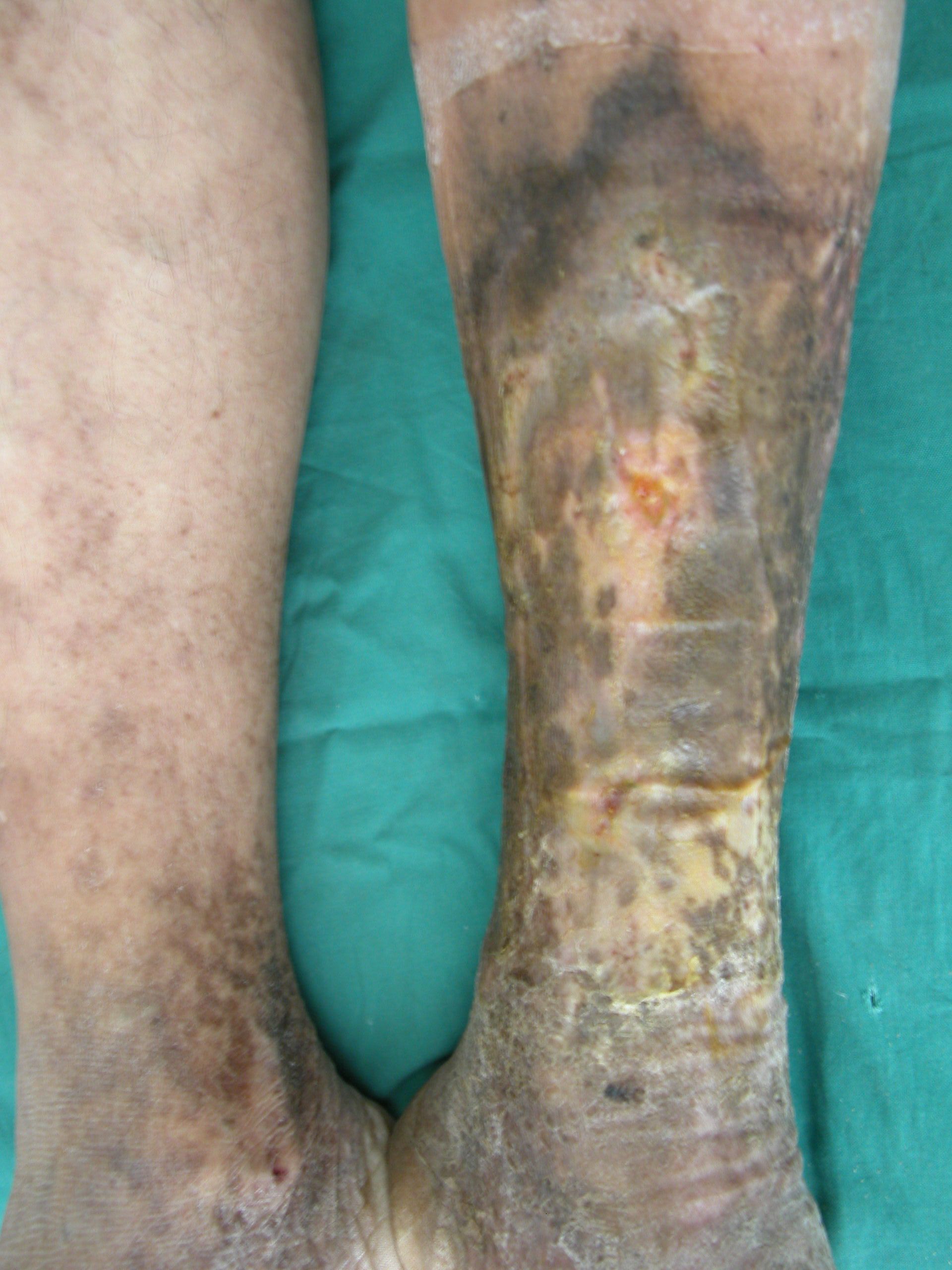 Varicose vein with healed ulcer