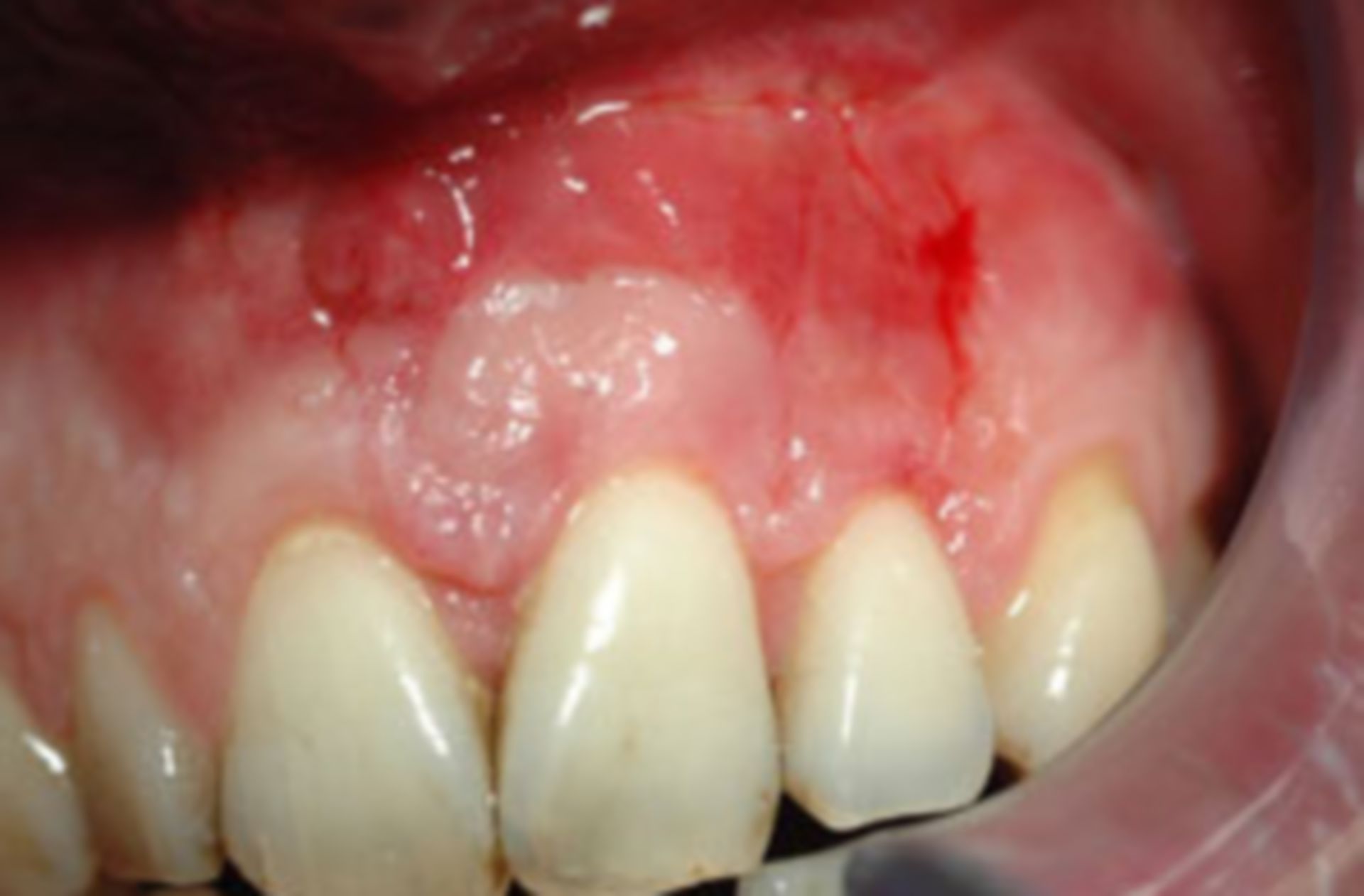 Intraoraler Befund mit ausgeprägter Zahnfleischentzündung.