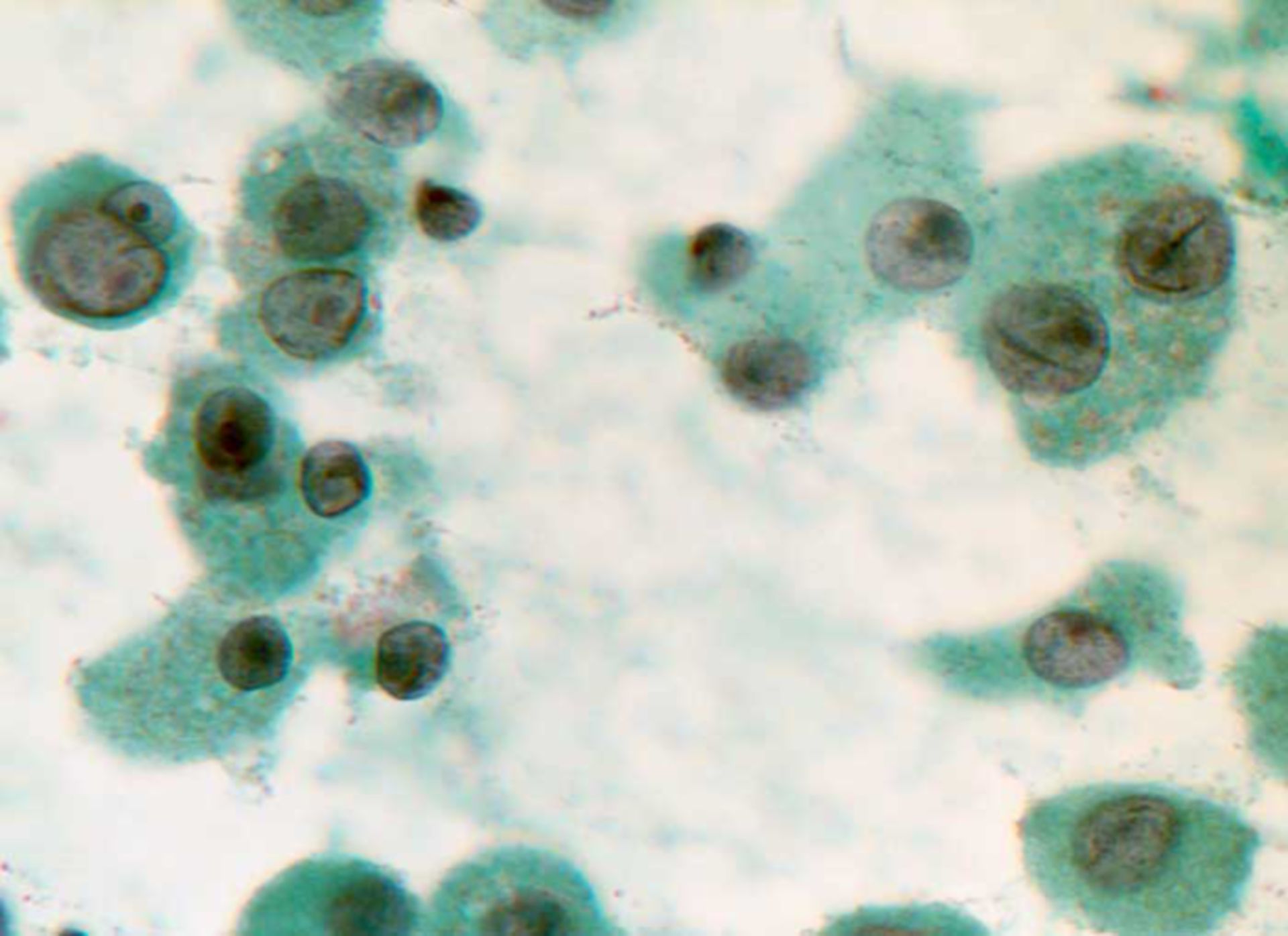 Oncocytic microfollicular neoplasia