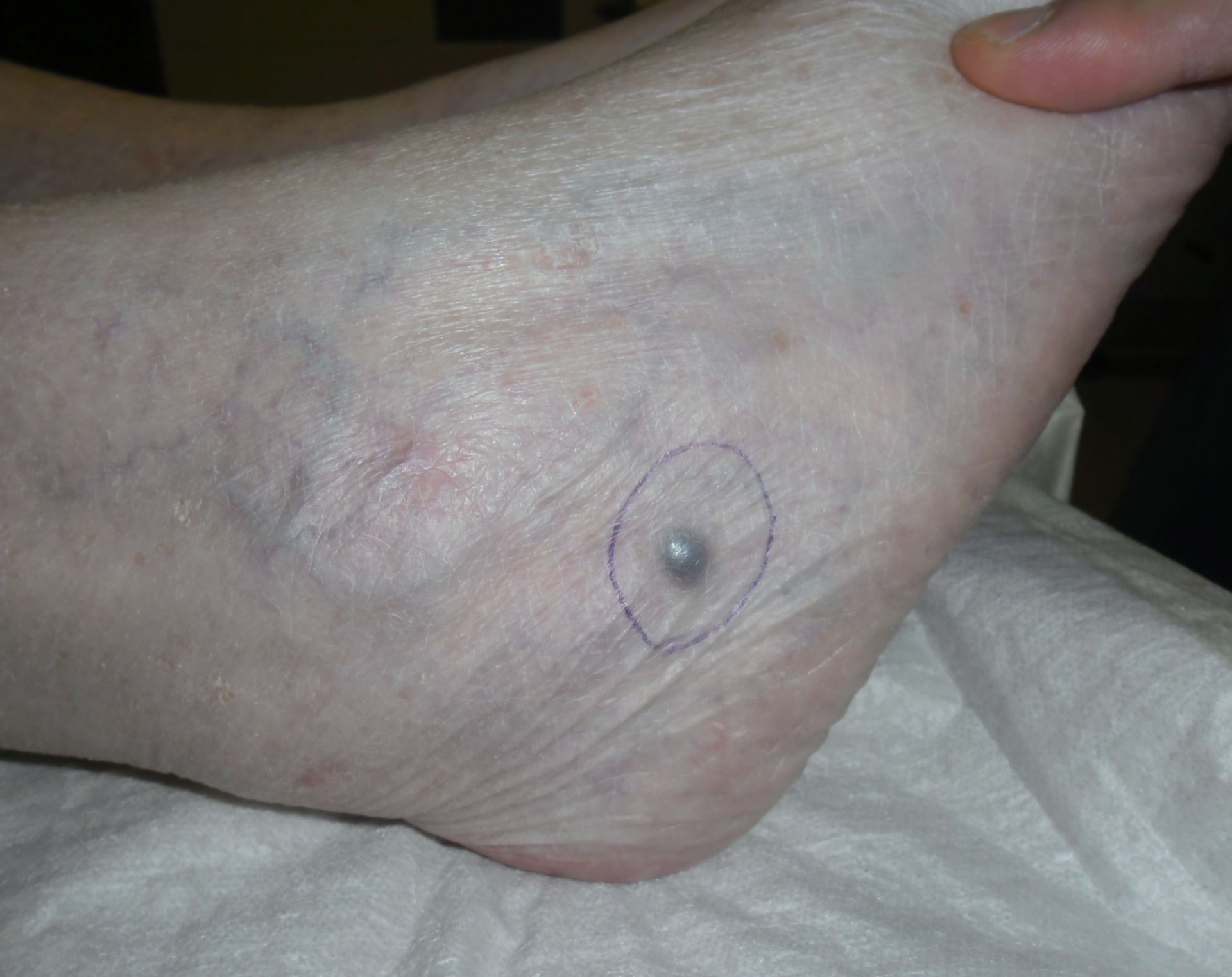 Melanoma - Metastasis on the foot