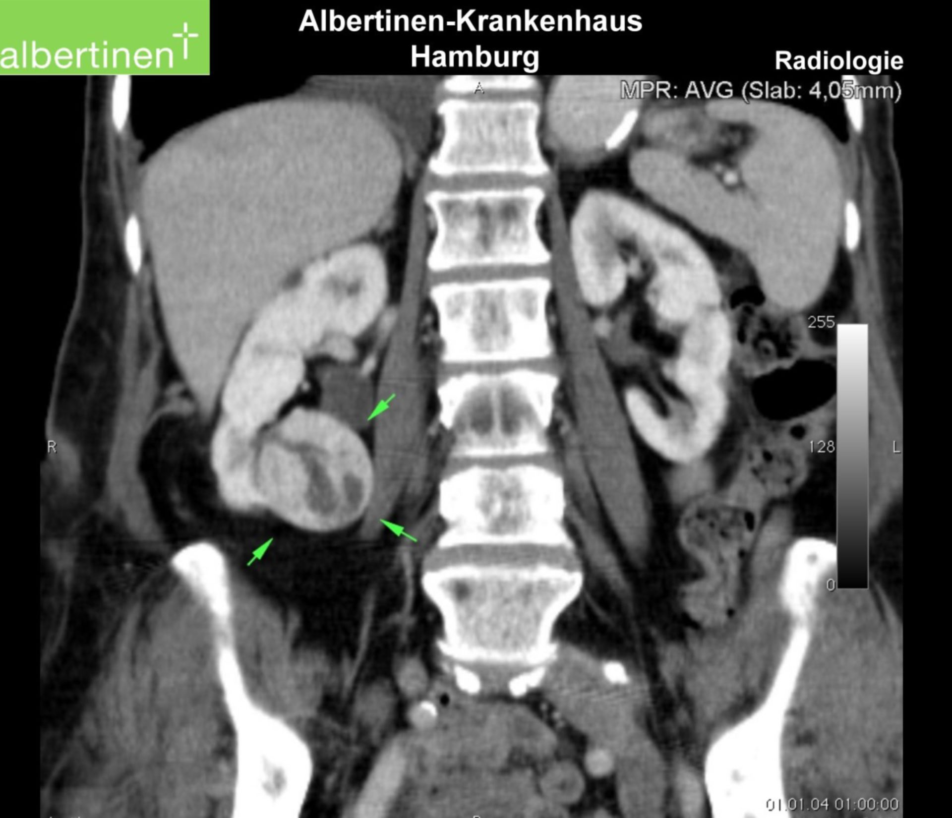 Kidney tumor, right side, CT