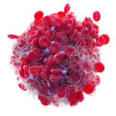 Thrombus DocCheck Flexikon