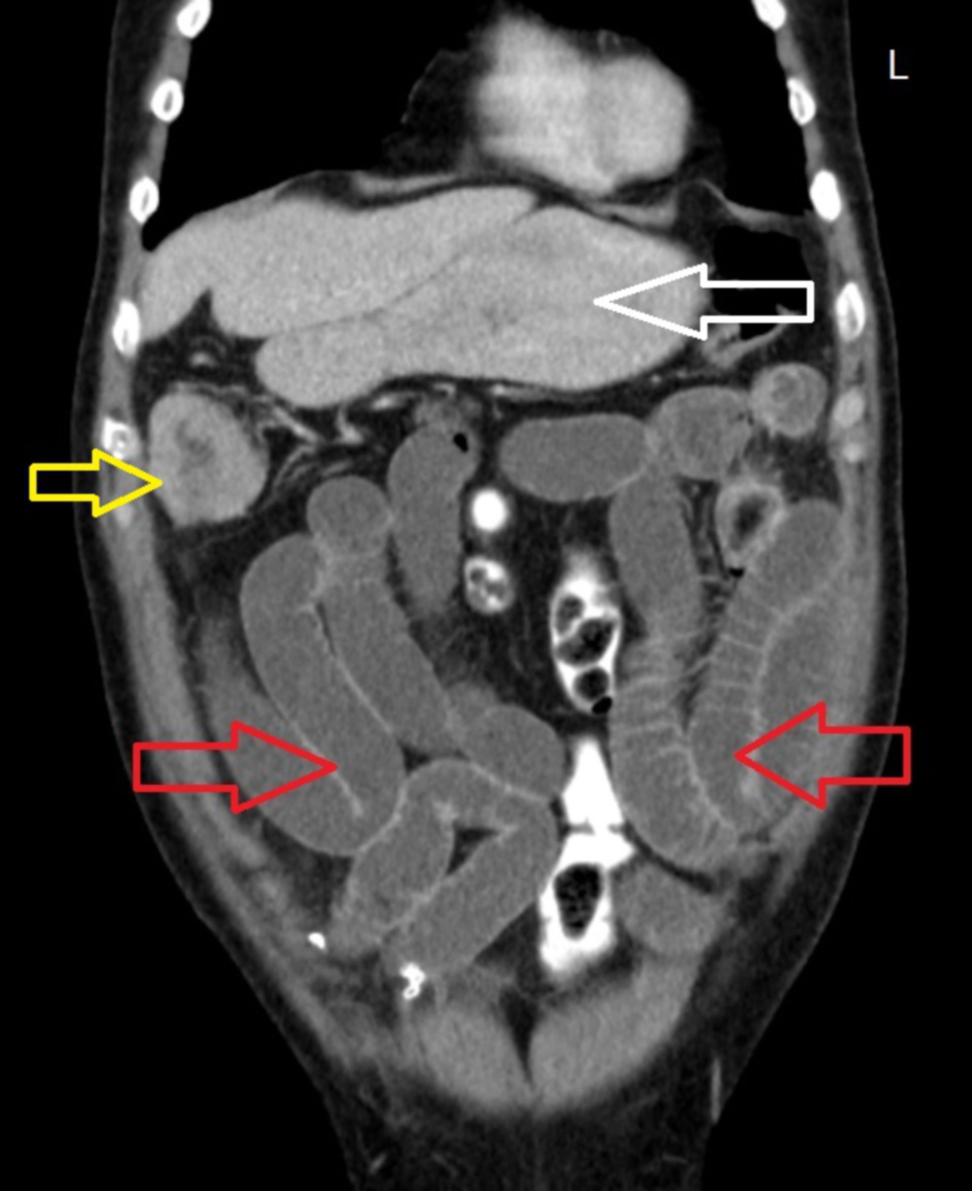 cor2: CT des Abdomens in frontaler Ebene