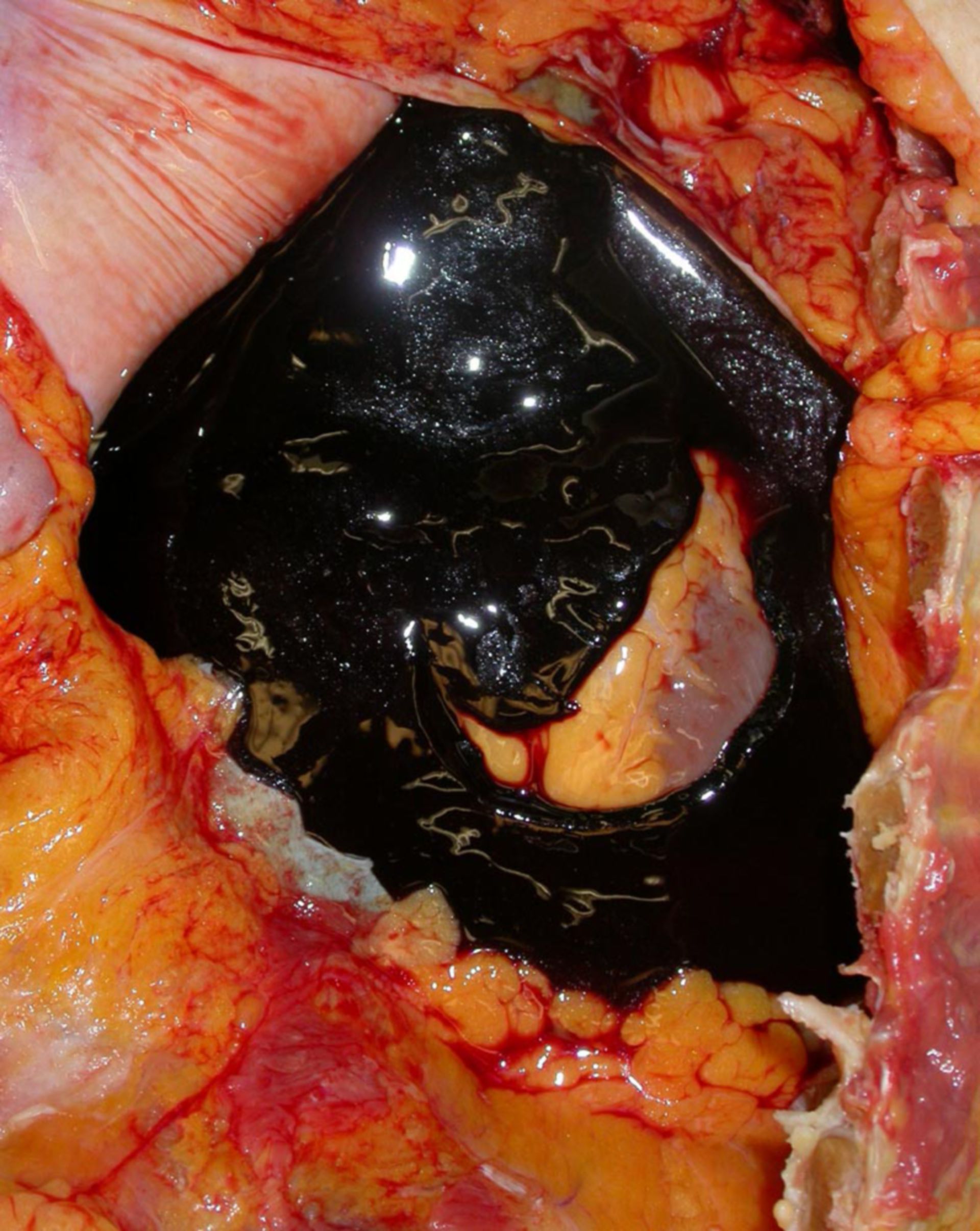 Cardiac tamponade