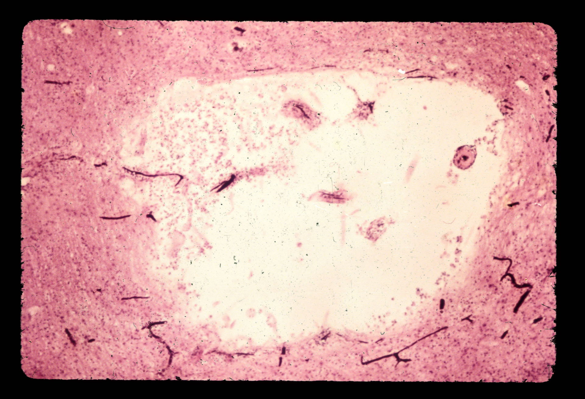 Necrosis micro