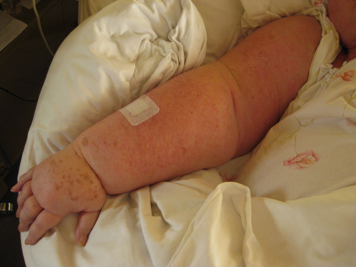 Lymphödem rechter Arm nach Mamma-Carcinom OP vor 20 Jahren