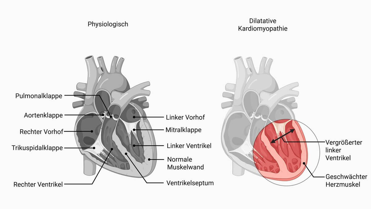 Dilatative Kardiomyopathie