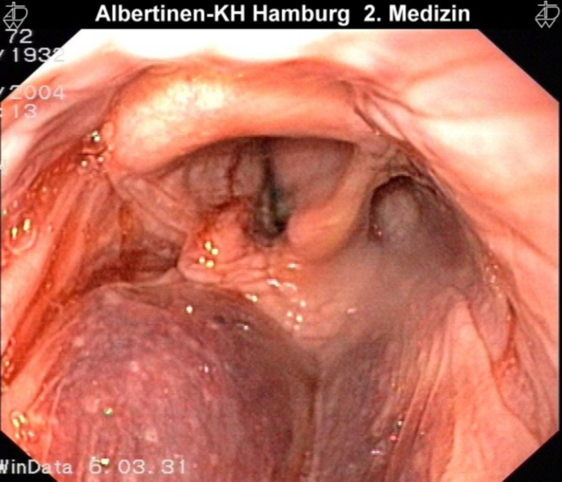 Hematoma of the larynx