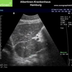 Hypertrophie DocCheck Flexikon