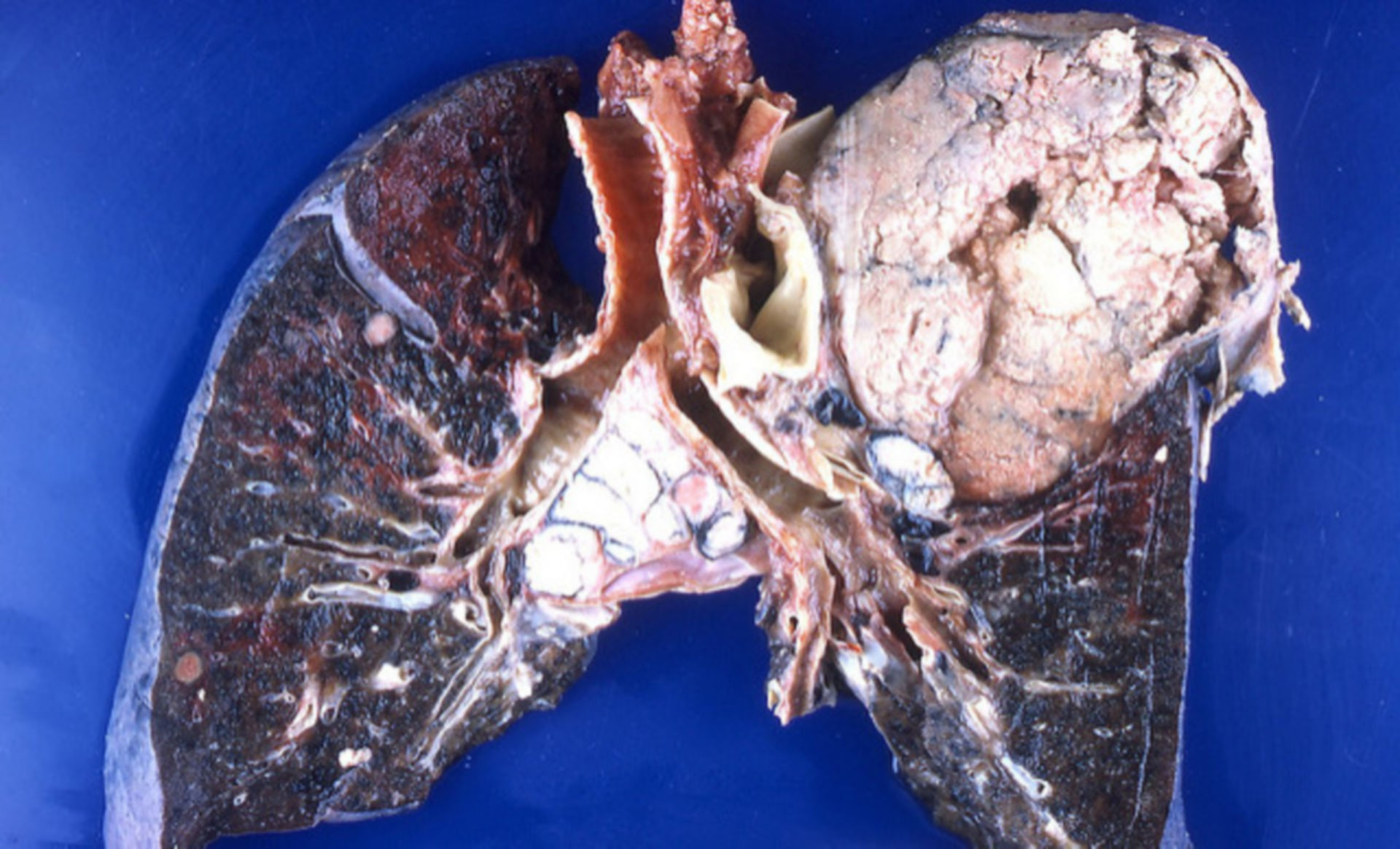 Bronchialkarzinom (Lunge, Präparat)