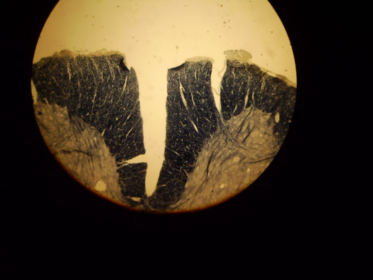 Tabes dorsalis (Lues) DocCheck