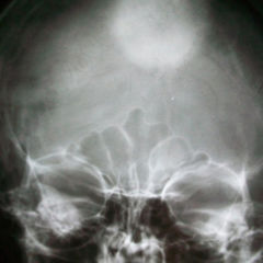 Hyperdens - DocCheck Flexikon