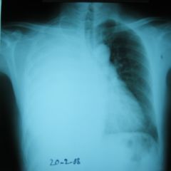 Verschattung - DocCheck Flexikon
