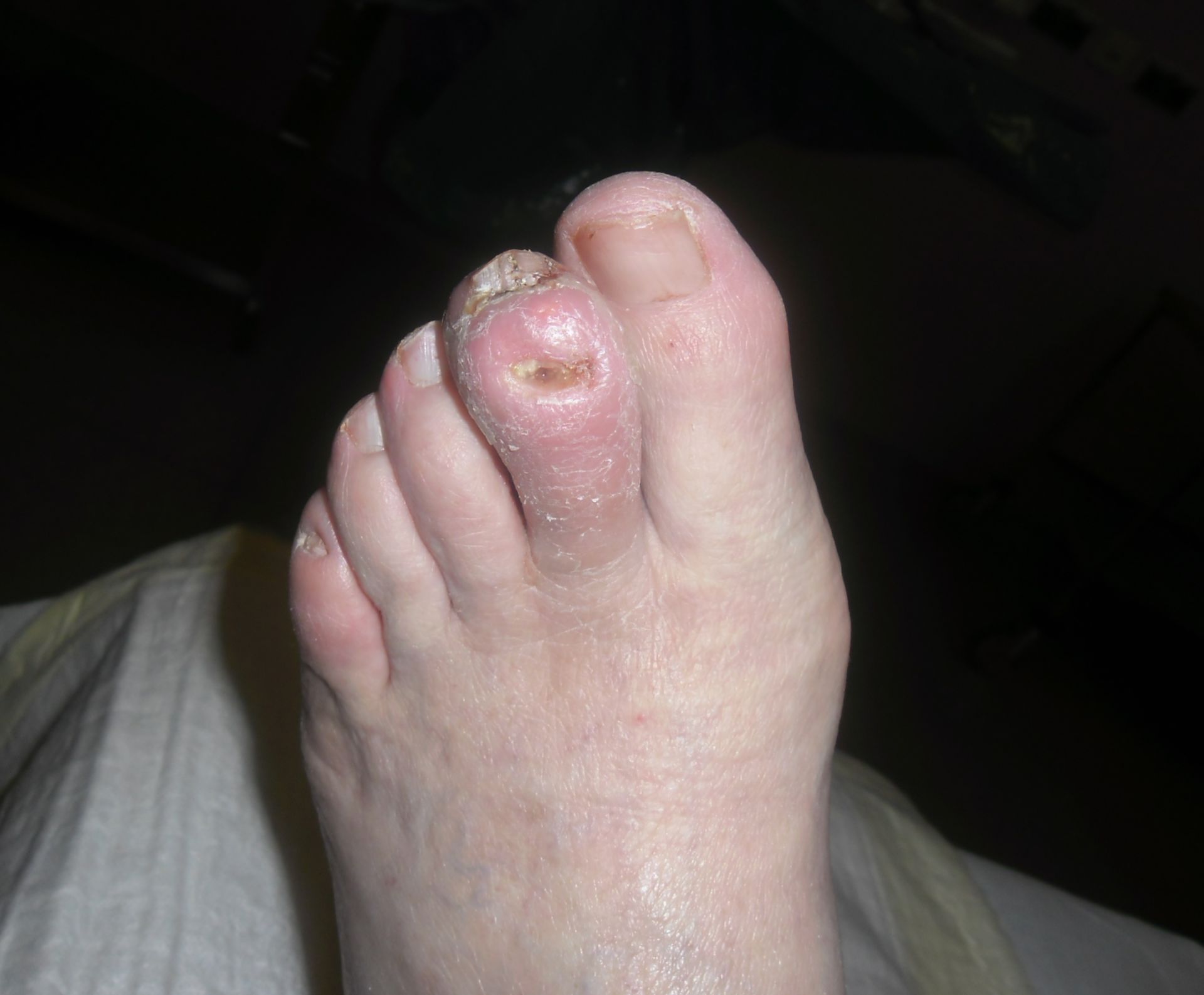 Gout- Arthritis urica second toe