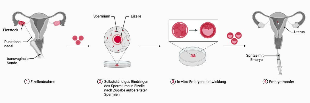 Ablauf In-vitro-Fertilisation