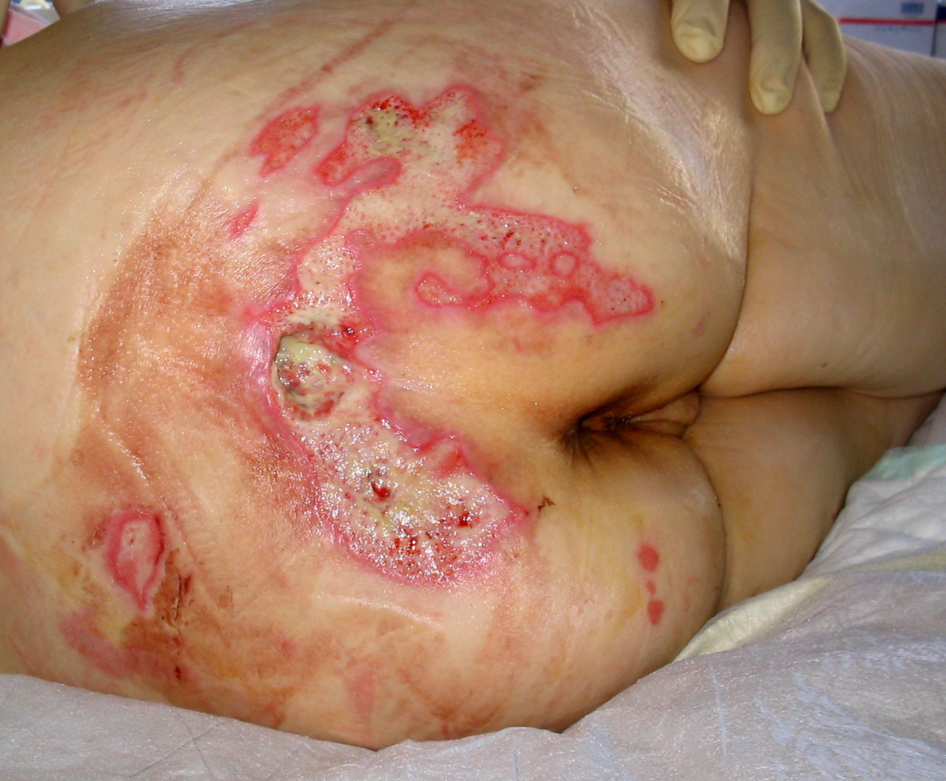 Decubitus ulcer