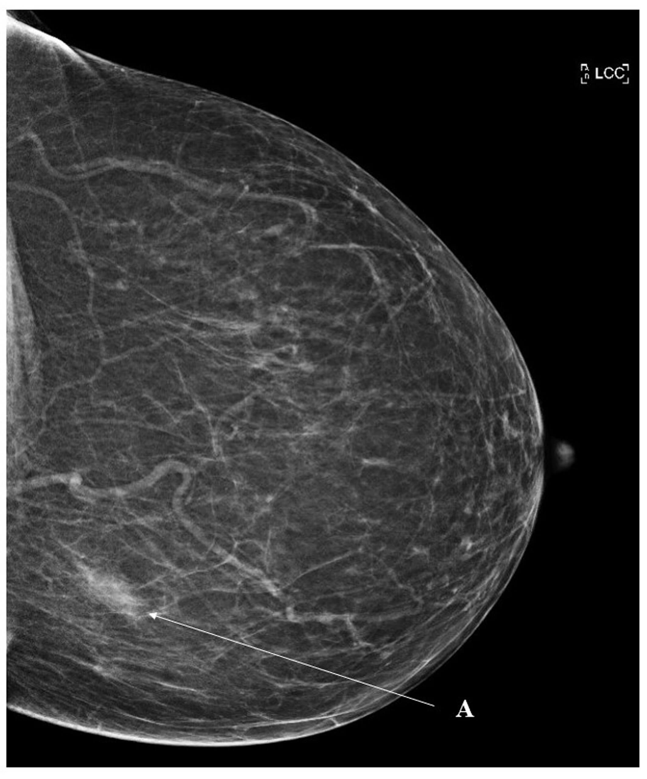 doccheck_-_02_-_casereport_filarie_bild1_mammographie_300dpi_original.jpg