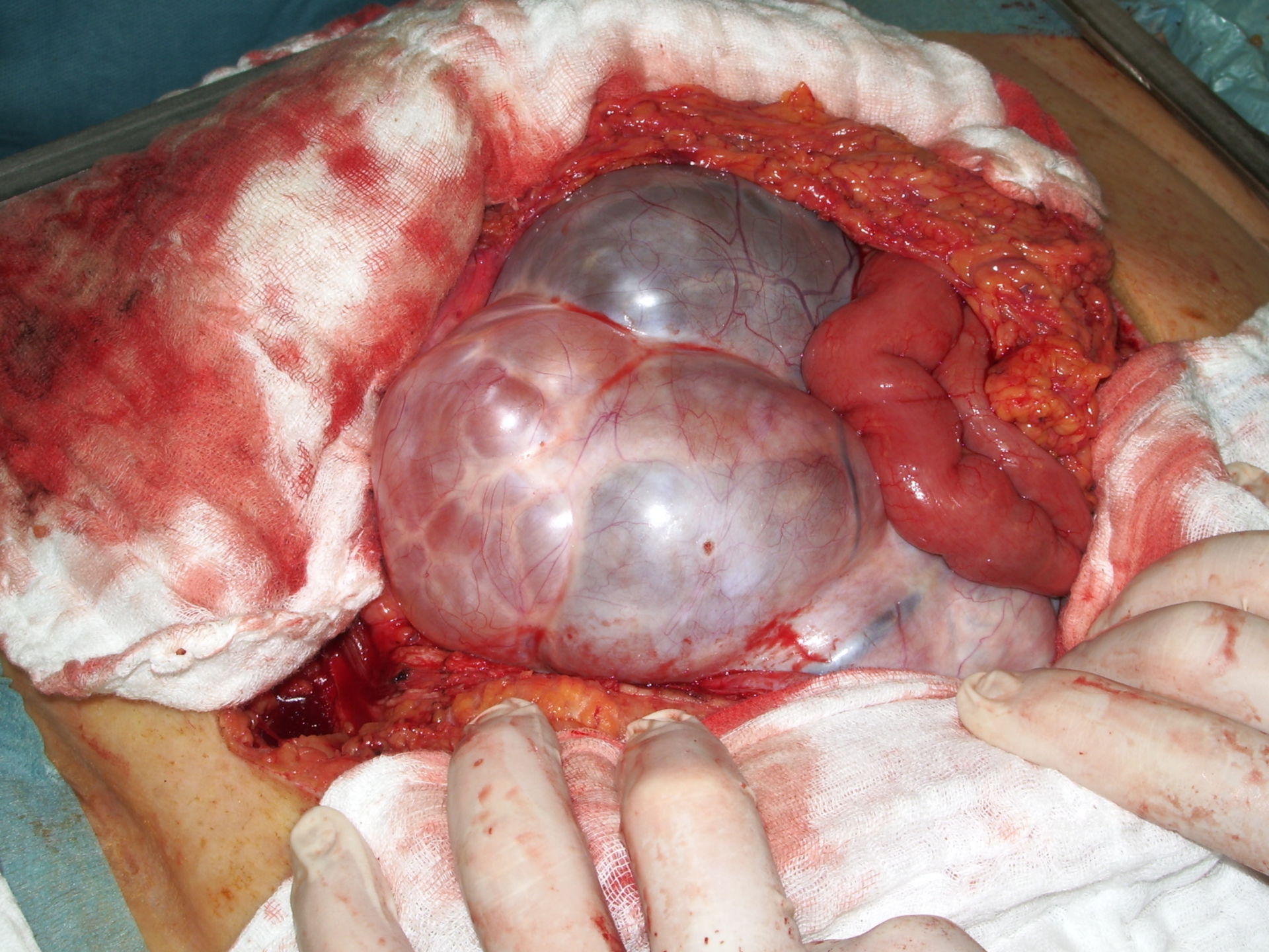 Ovarial Tumor  -Kindskopfgroß