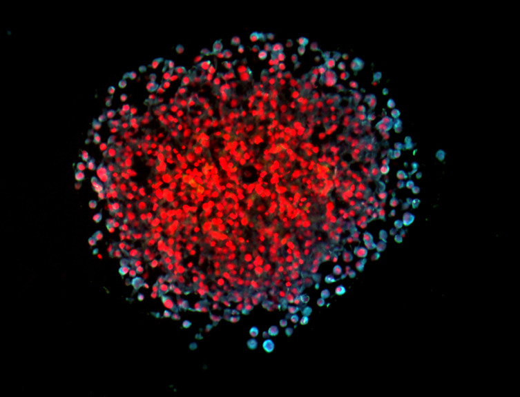 Verband von Brustkrebszellen. Invasive Zellen erscheinen hellblau. Nicht-invasive Zellen sind rot gefärbt.