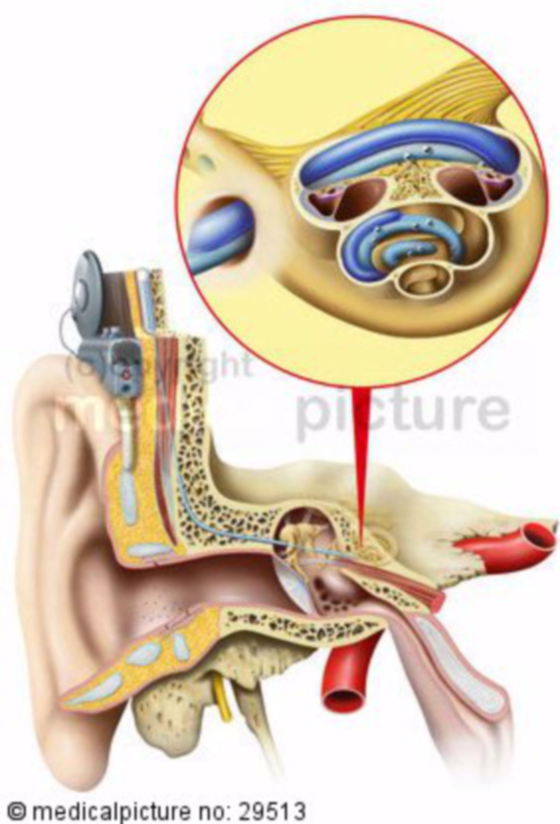  Modell eines Cochleaimplantats 
