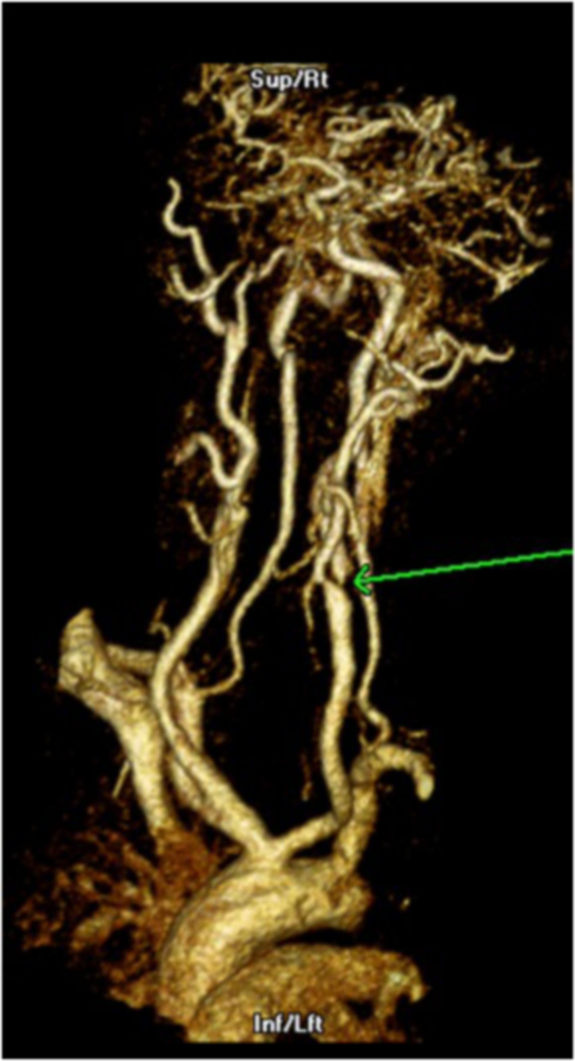 CT- Angiographie einer Carotisstenose