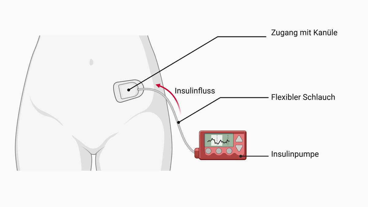 Schematische Darstellung einer Insulinpumpe