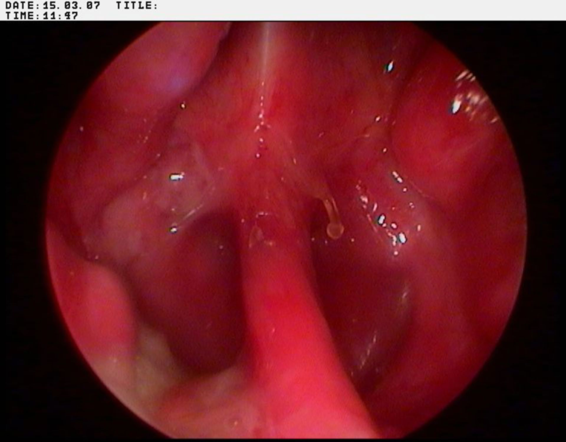 Removal of the nasal septal structure