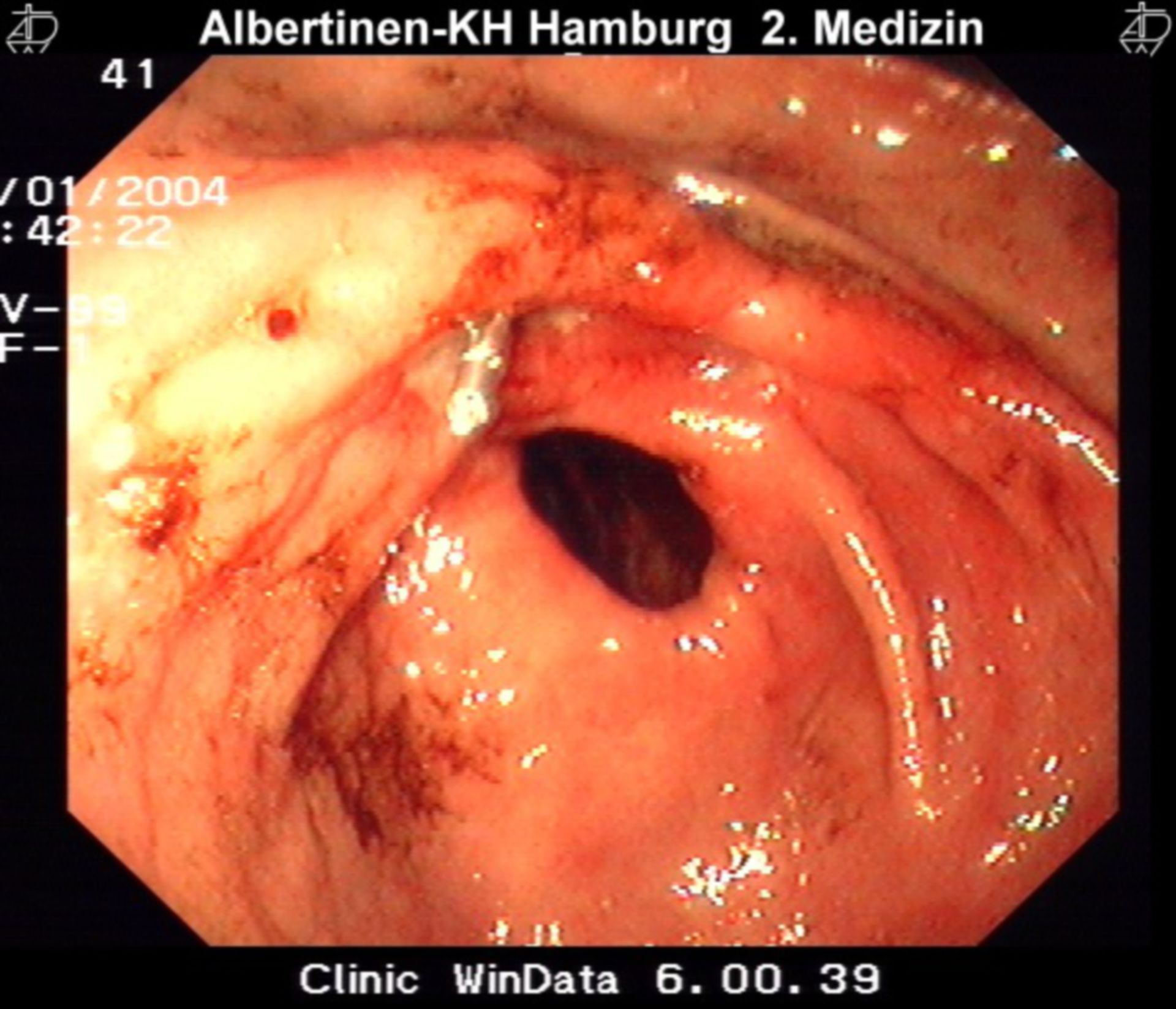 Ulcer after clipping