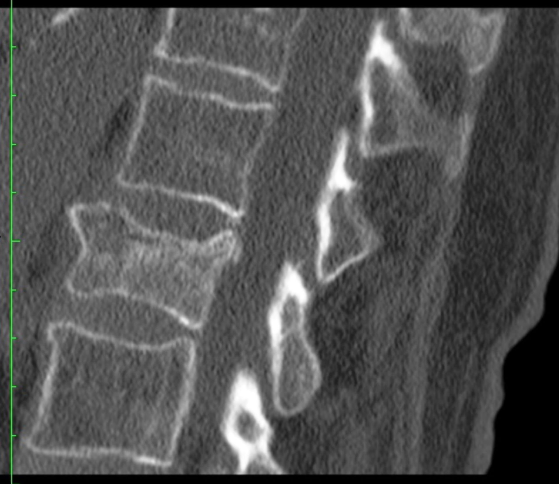 CT der LWS in sagittaler Ebene mit LWK-1 Berstungsfraktur