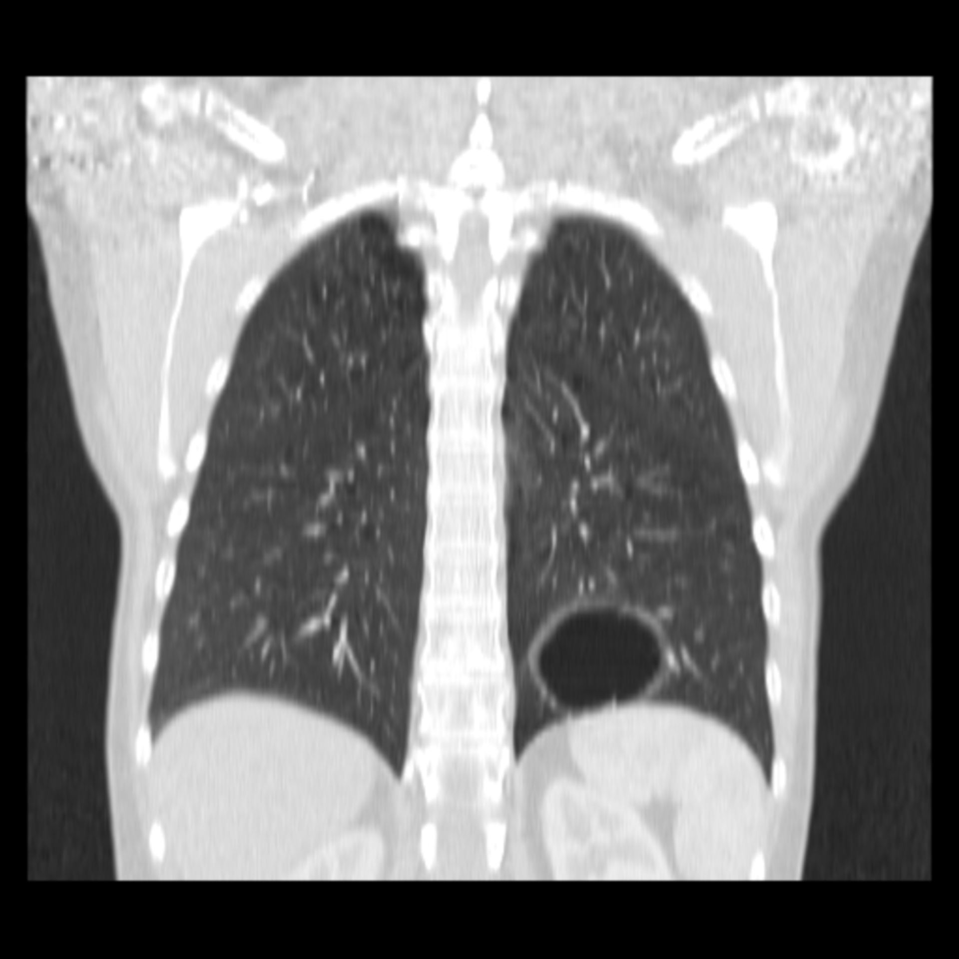 ct_cor200001: CT des Thorax in frontaler Ebene