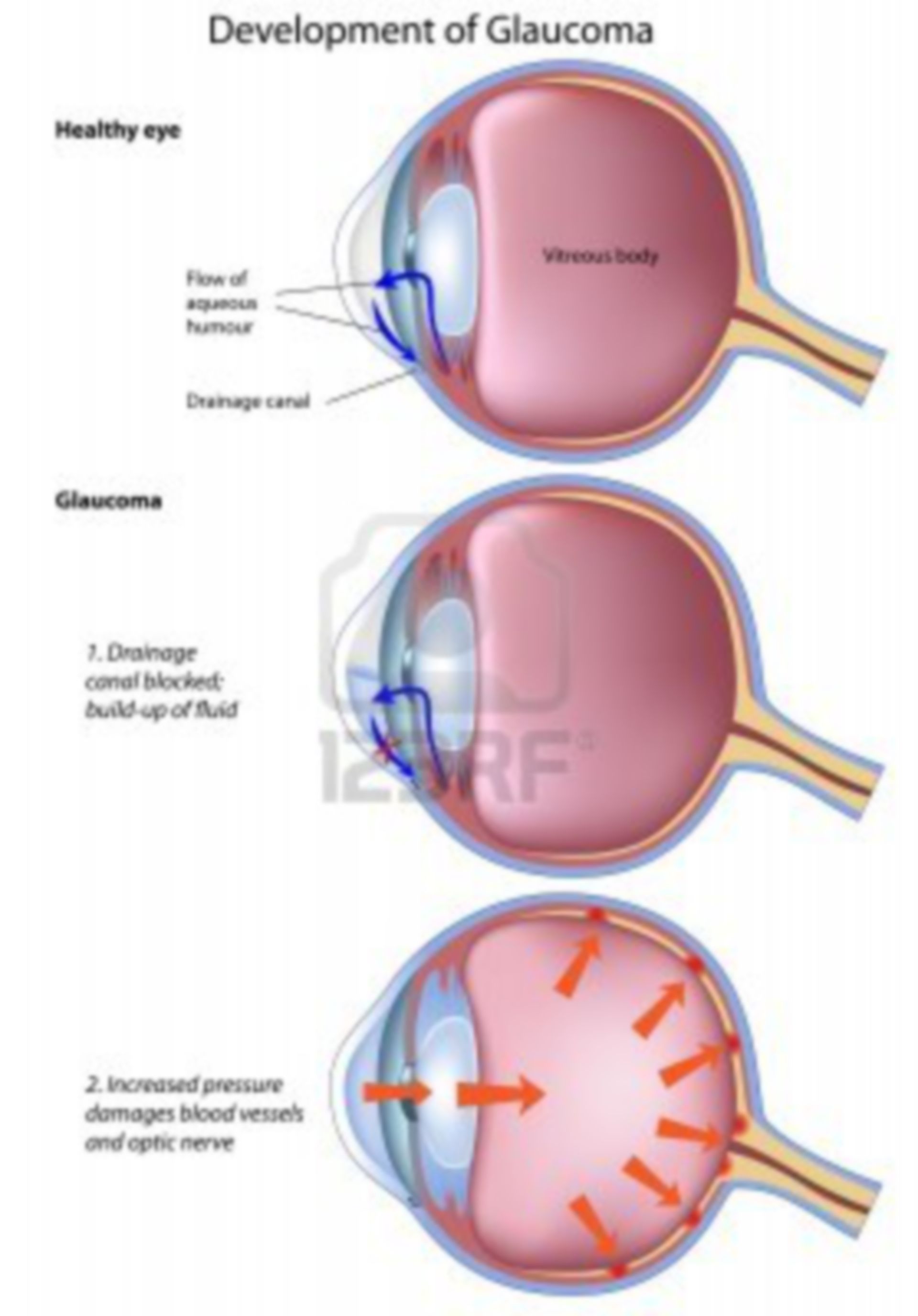 Entwicklung von Glaukom