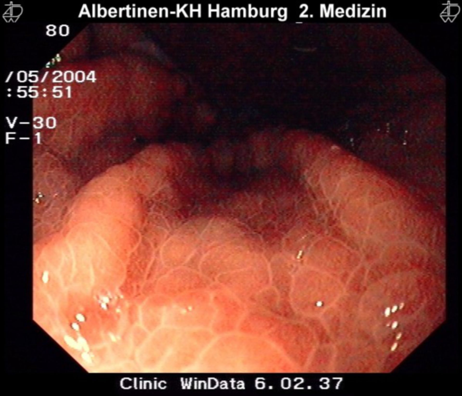 Hypertensive gastropathy5