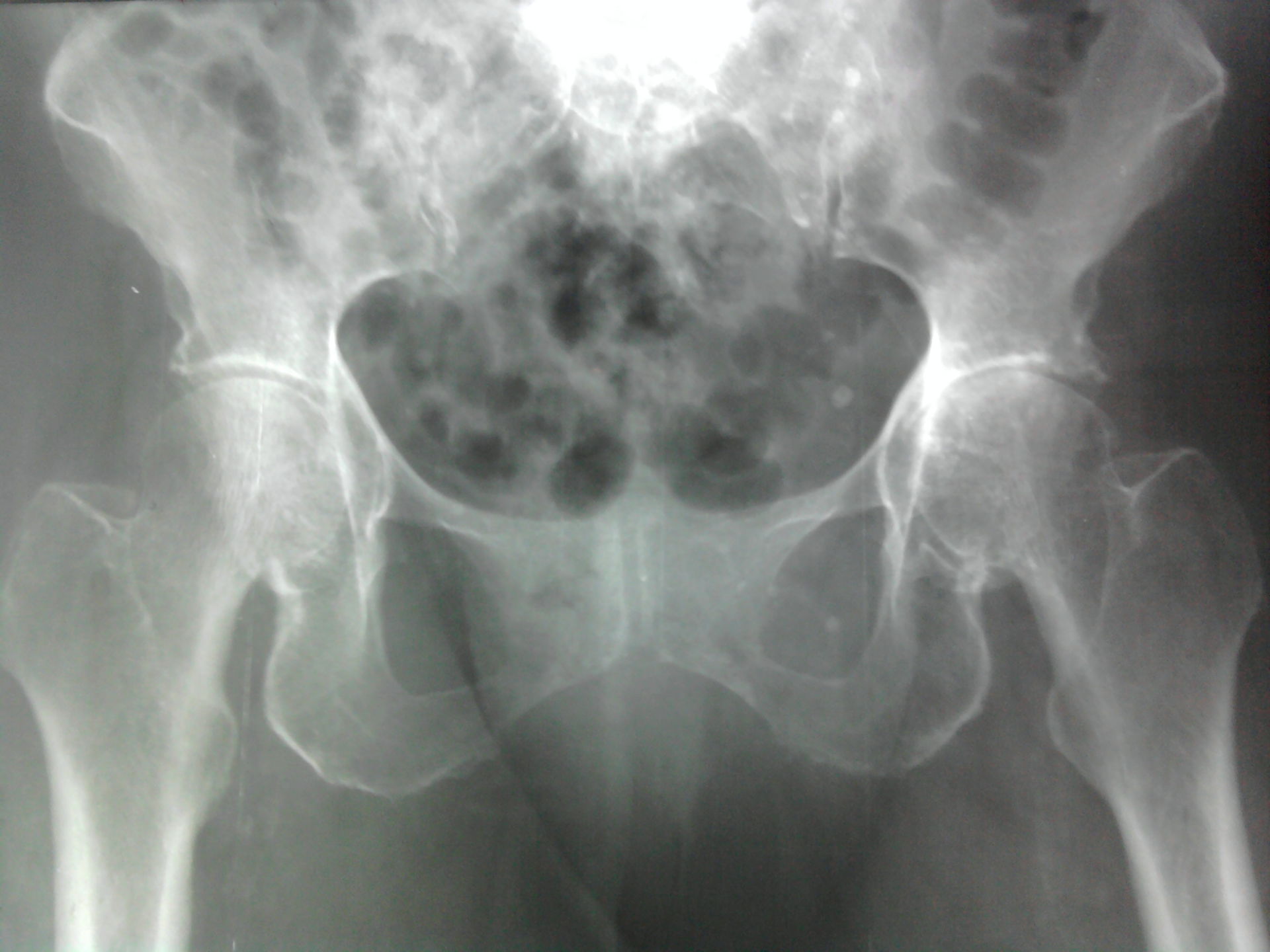 Osteoartrite dell'anca