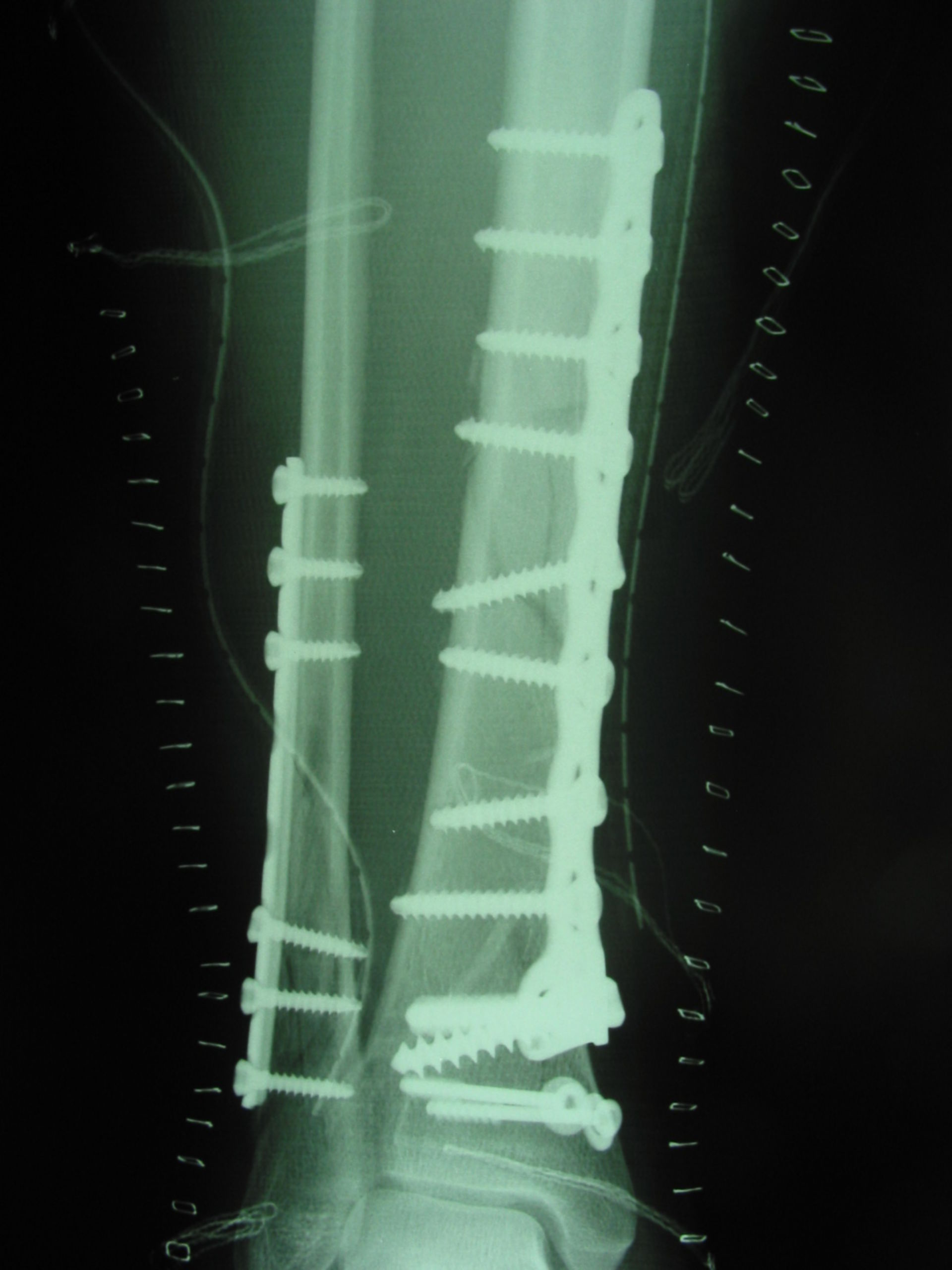 Lower leg fracture, plate fixation