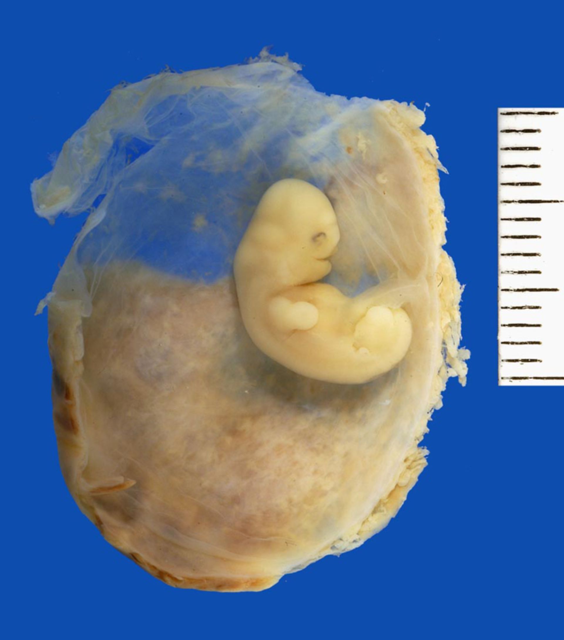 Embryo in amniotic sac