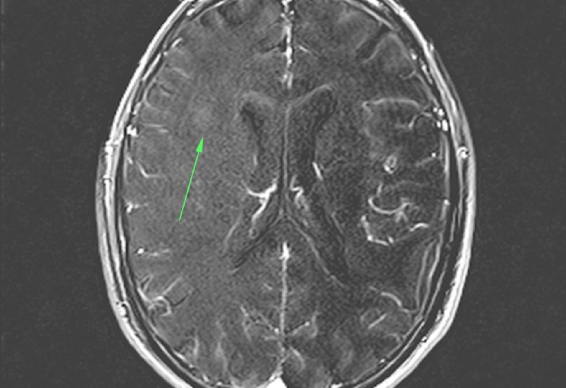 MRT des Schädels in transversaler Ebene mit okkultem MS-Herd im Bereich der rechten Hemisphäre