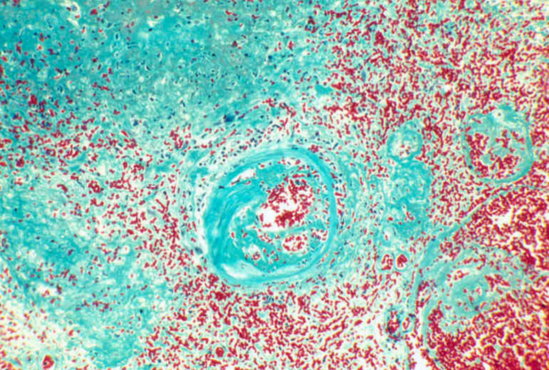 Haemorrhages, microscopic view